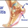 plantar-fasciitis picture