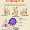 Ankle_Sprains_V2-640