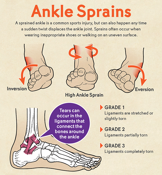 Ankle_Sprains_V2-640