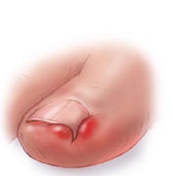 ingrown-toe-nail