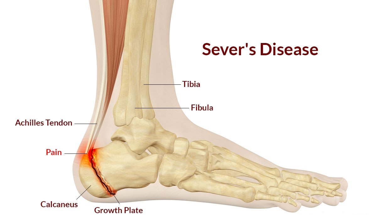 severs-disease3