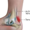 Achillies Tendinitis