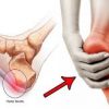 Plantar Fasciitis Image